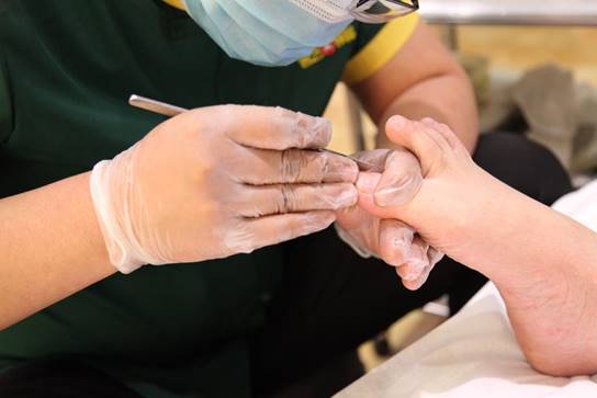 Paronychia Treatment 修脚 甲沟炎 去死皮