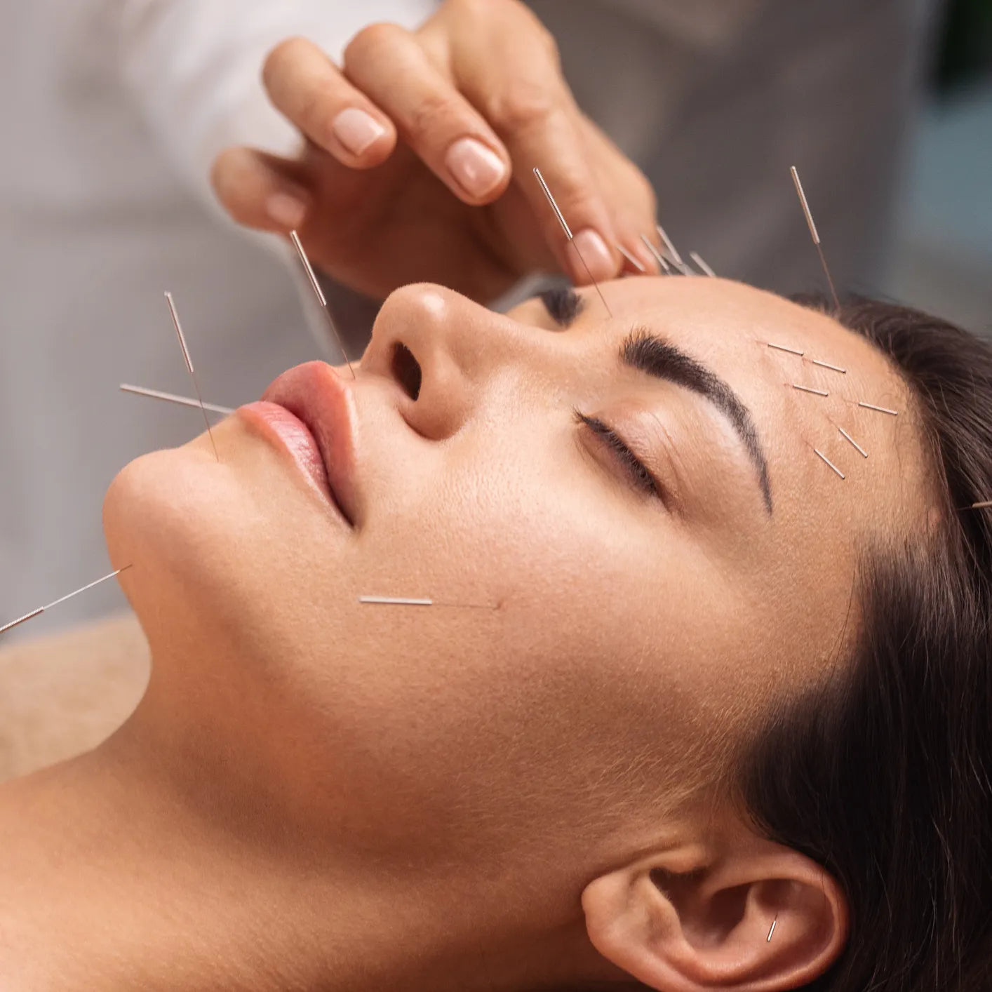 Acupuncture Treatment 针灸治疗