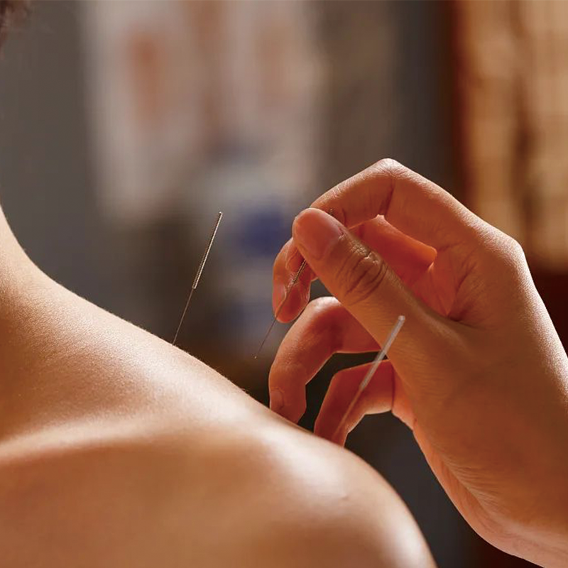 Acupuncture Treatment 针灸治疗